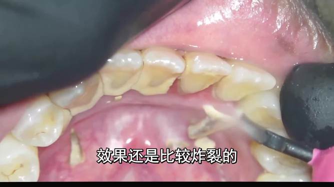 最新去牙垢,最新去牙垢,从齿间焕新,到人生焕然